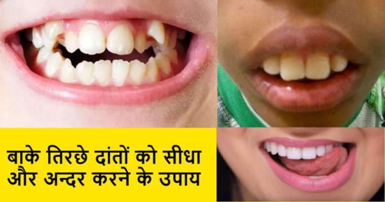 Image result for क्या आपके दांत टेढ़े मेढ़े है,